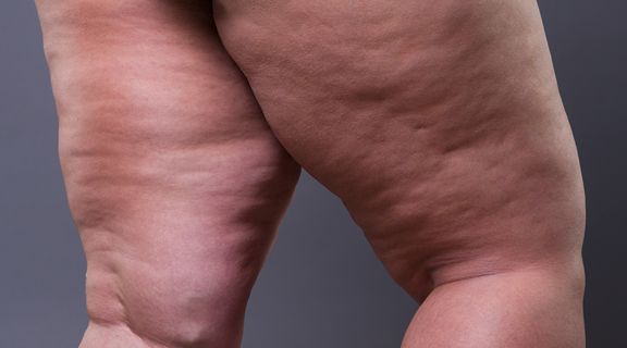 Lipedema_8dda3605d3.jpg