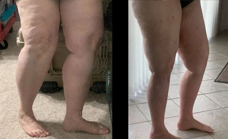 lipedema-antes-e-depois17.jpg
